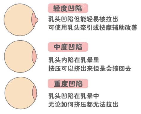 男生奶頭有毛|乳頭內凹、長毛正常嗎？ 8類「乳頭形狀」你的是哪種 